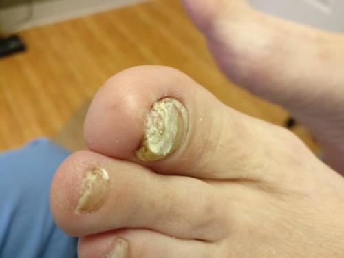 Keratin granulations and big toenail fungus.