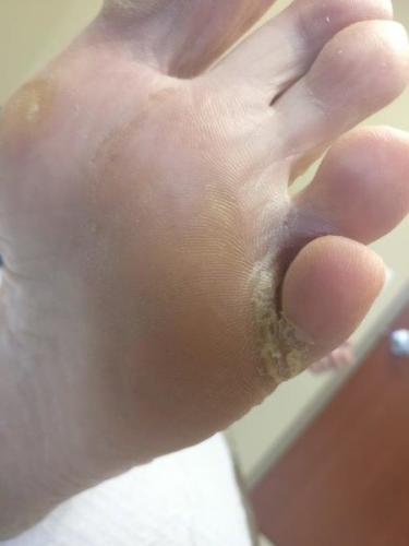 Severe Athlete's foot between the toe interdigital tinea pedis