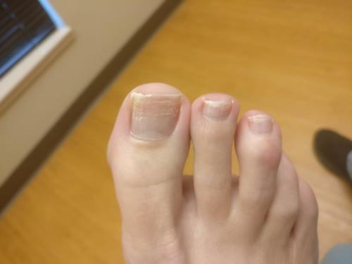 Keratin granulations after removing toenail polish.