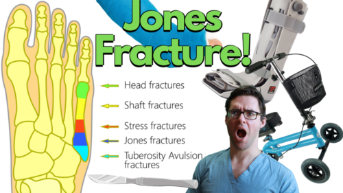 5th metatarsal fracture jones fracture.