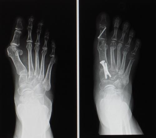 Lapidus bunionectomy before and after surgery