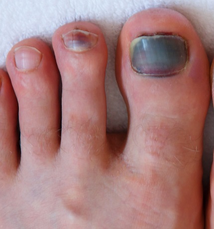 Human male foots with bruised black on toe nails on white background .