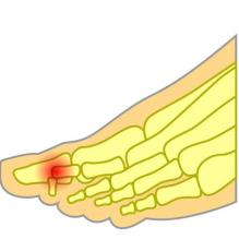 Mallet toe pain 2nd toe joint