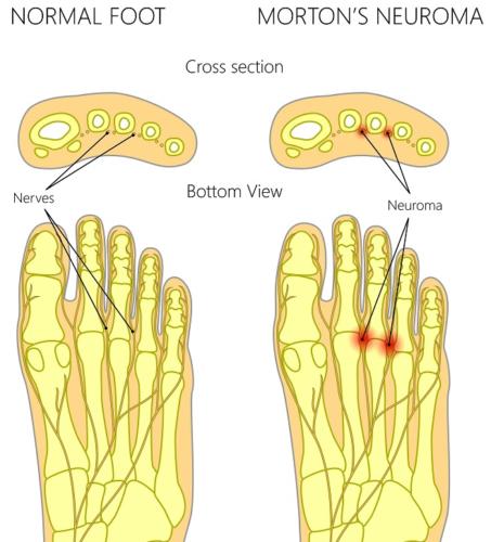 Morton's Neuroma ball of the foot pain treatment