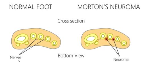 Morton's Neuroma ball of the foot pain