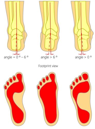 pronated vs. supinated heel pain