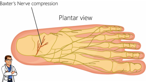 Pinched nerve in the heel bone Baxter's Nerve