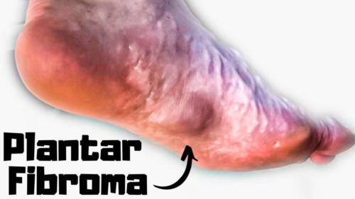 plantar fascial fibromatosis