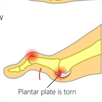 Plantar plate injury to the 2nd toe joint with tear repair