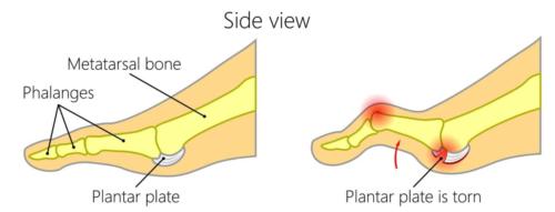 Plantar plate tear injury to the 2nd toe joint lateral view