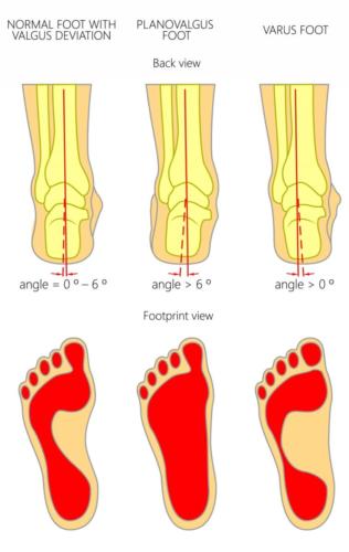 Pronated foot vs supinated foot heel pain