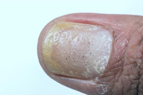Toenail psoriasis and nail pitting. Fingernail psoriasis.