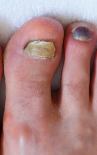 Human male foots with bruised black on toe nails on white background .