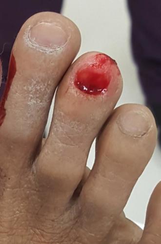 Ripped off right 3rd toe with bleeding and red spot
