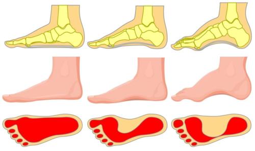 Bony bump on top of the foot due to cavus foot