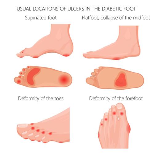 Staph infection of the foot, toe, ball of the foot and heel.