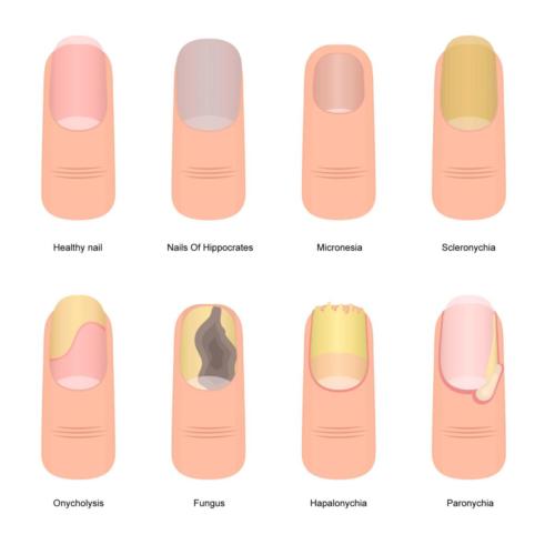Different types of toenail disease. Note: this is not a comprehensive list!
