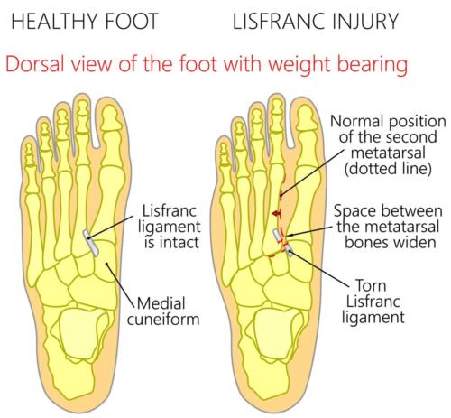 Lisfranc fracture pain top of foot