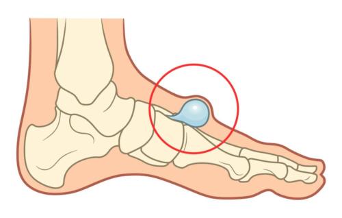 Swollen Bump on Top of the Foot Ganglion Cyst