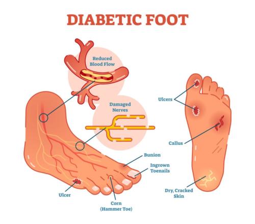 Diabetic foot ulcer locations.