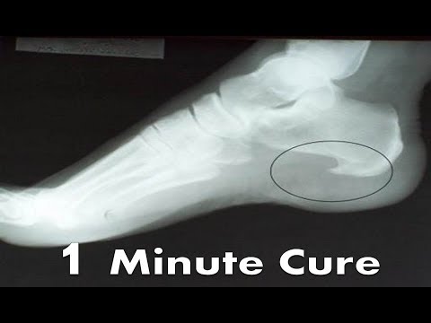 Corn & Callus Treatment Michigan — Permanent Relief