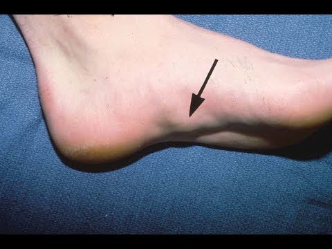 Bottom of the Foot Nodules & Bumps *Home Treatment*