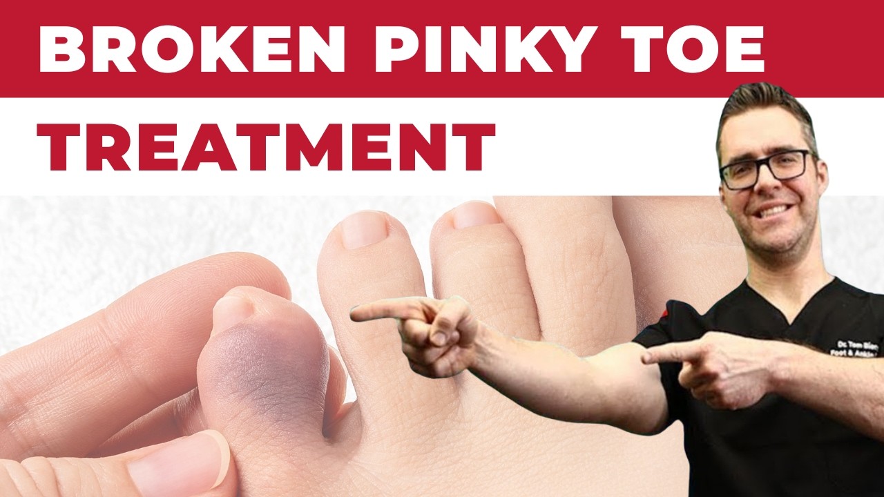 What To Do For A Broken Pinky Toe [How To Tape & Little Toe Treatment]