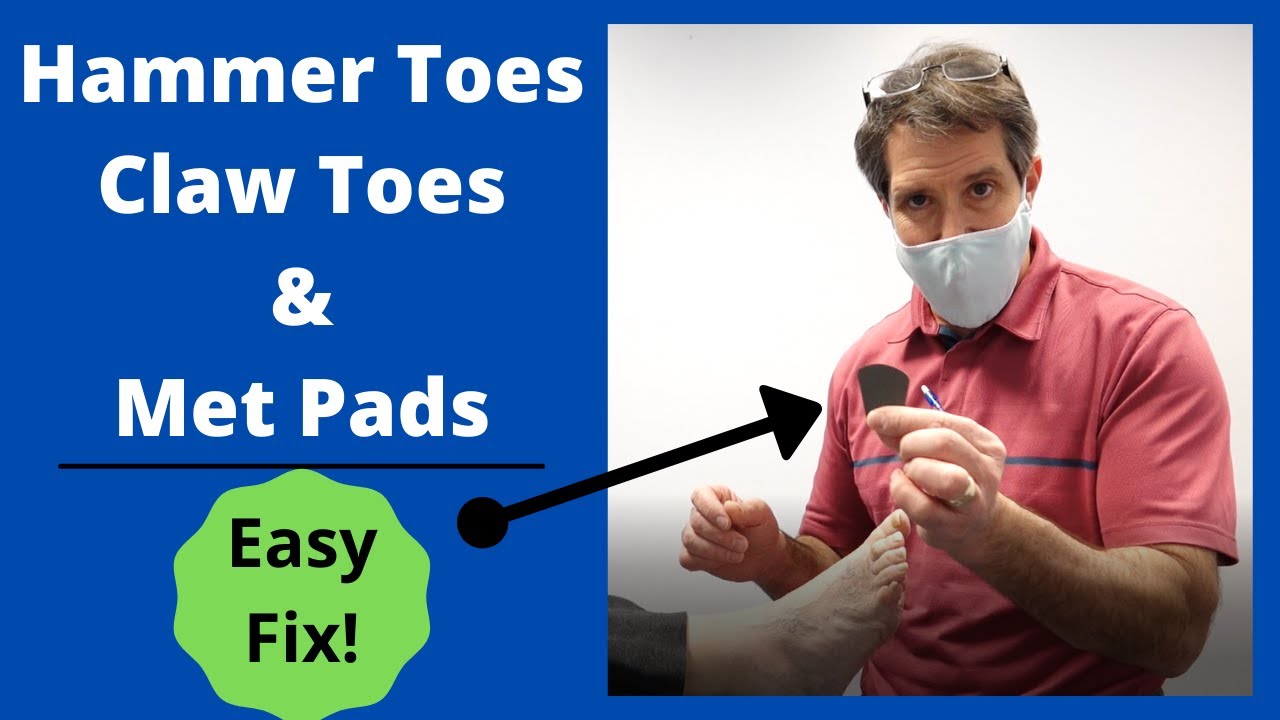 Hammer Toes, Claw Toes and Metatarsal Pads — Easy Fix! | Dr. Tom Biernacki
