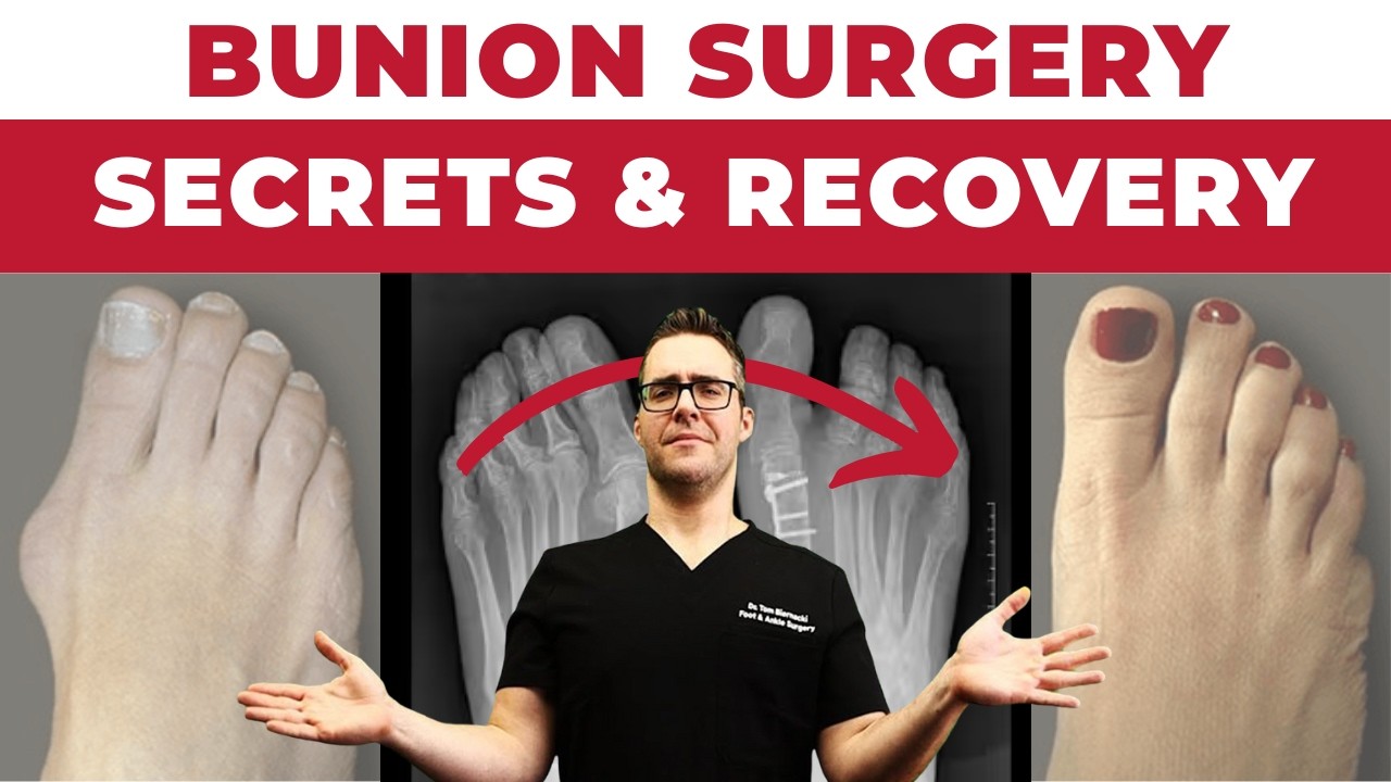 Bunion Surgery SECRETS & FAST Recovery [Bunionectomy vs Lapiplasty]