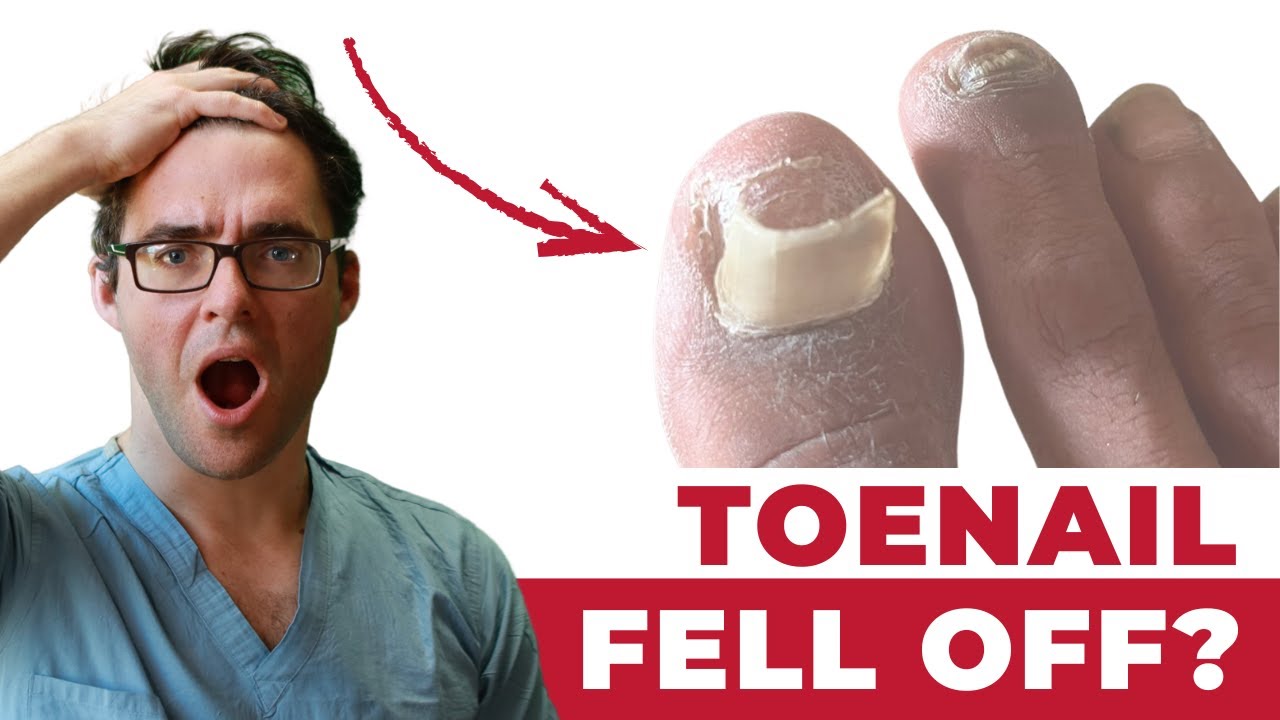 Toenail Falling Off? How To Make It Grow Back! [Top 4 Causes]