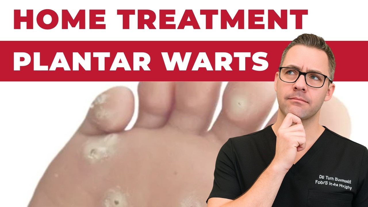 Plantar Warts Removal at Home Treatment  [Foot & Toe Wart Remedies]