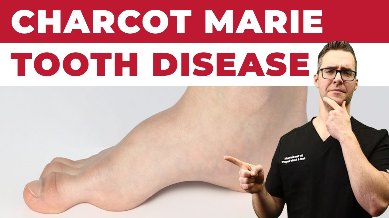 Charcot Marie Tooth Disease [Best Foot Treatment!]
