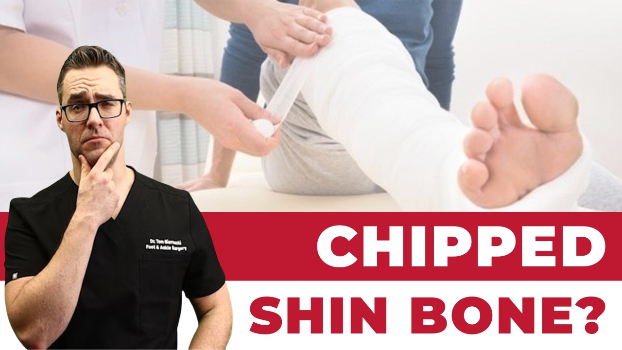 Do I Have A Chipped Shin Bone? *@ HOME Guide*