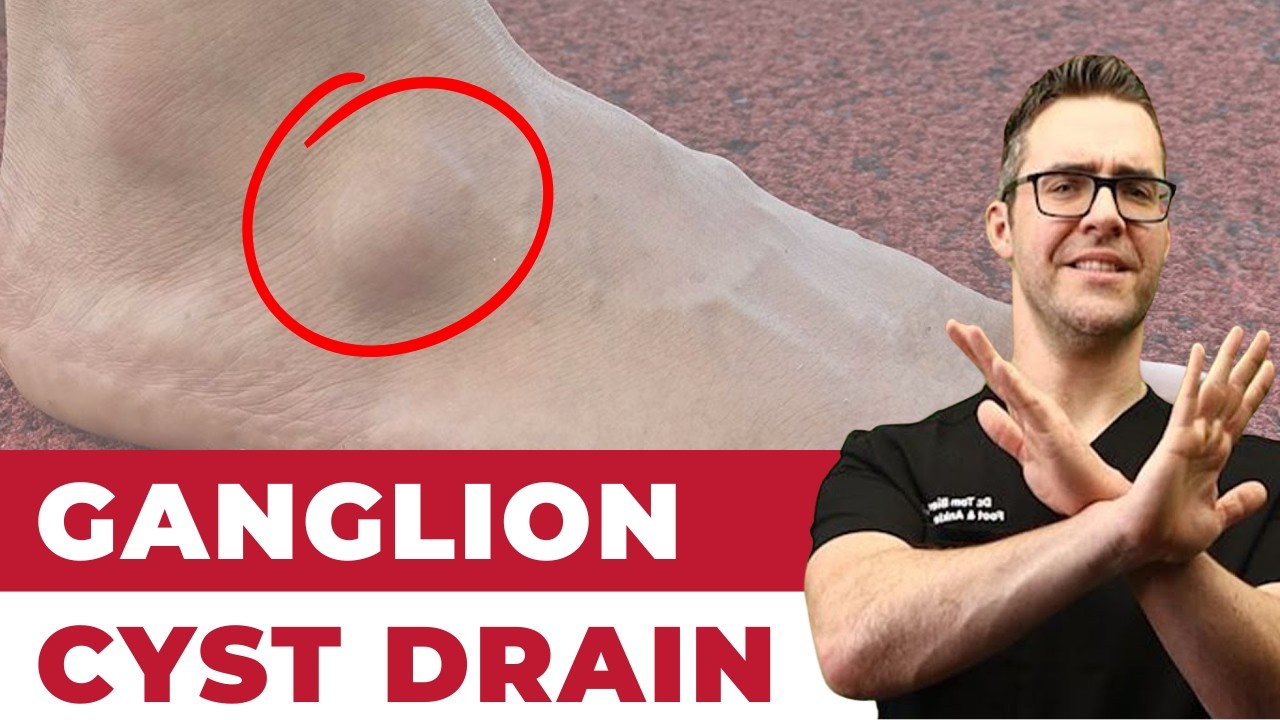 HUGE Ankle Ganglion Cyst Aspiration Surgery - *Foot & Ankle Treatment*