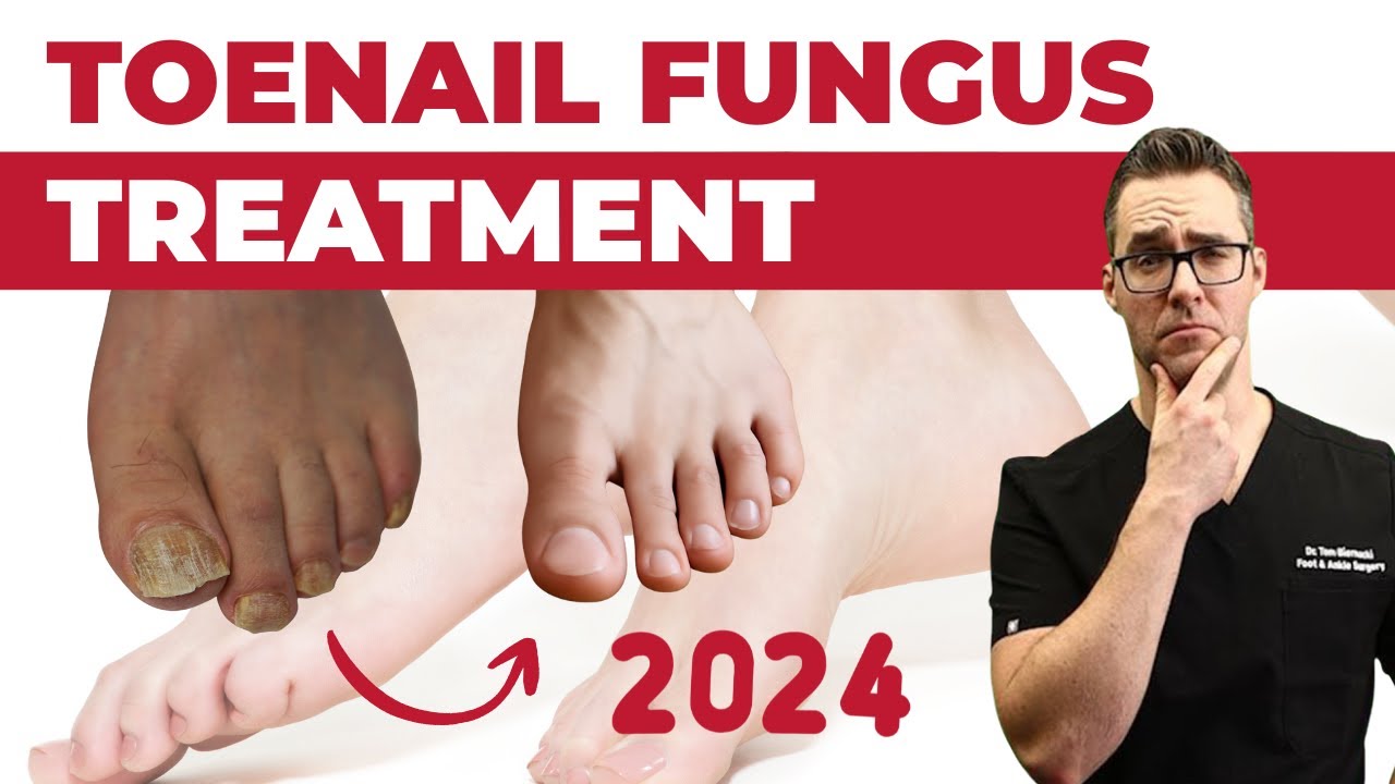 BEST Toenail Fungus Treatment 2024: 4 Big Secrets