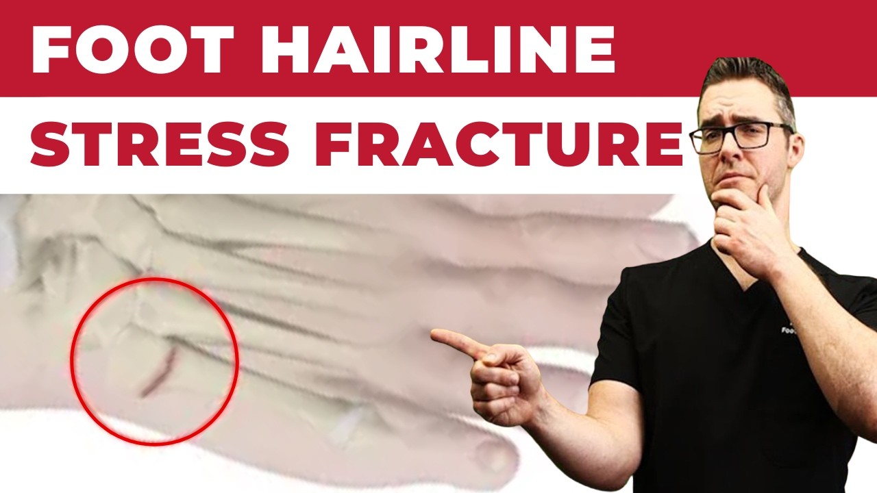 Stress Fracture In Foot? Warning Signs You Shouldn’t Ignore!