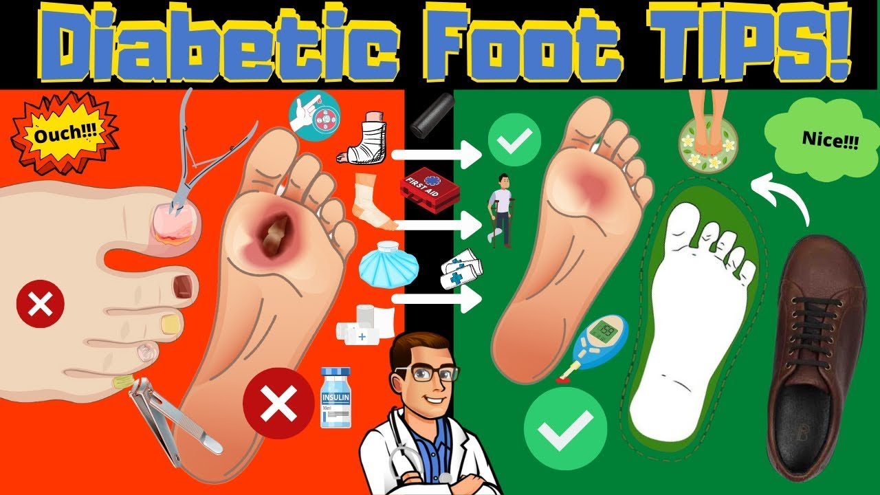 Diabetic Foot Treatment 101 [Symptoms, Pain Relief & Home PREVENTION]