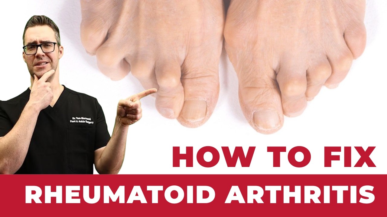 Rheumatoid Arthritis Stages Explained [What To Watch For And How To Treat]