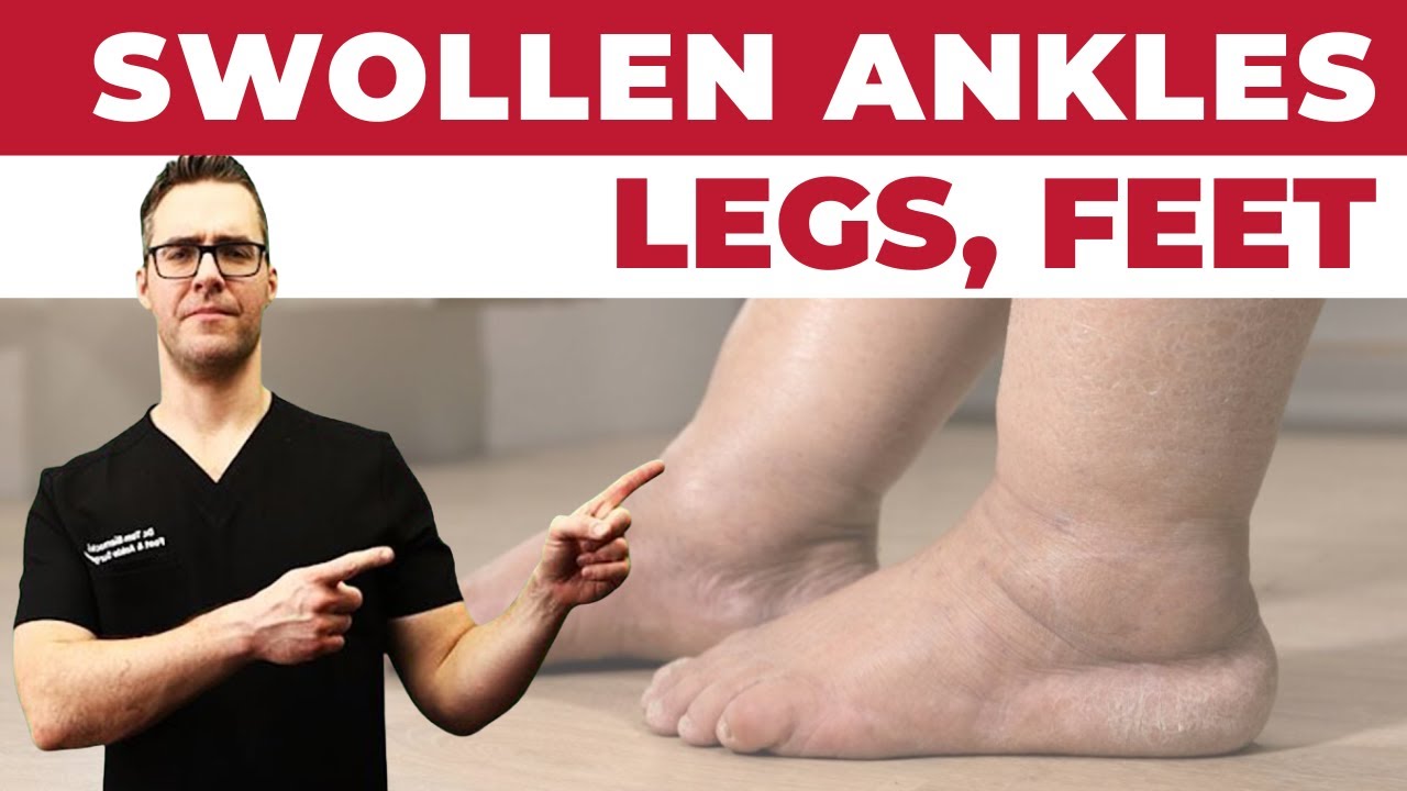 Stop These Mistakes Making Edema Swelling Worse! [Swollen Feet Ankles And Legs Fast Fix]