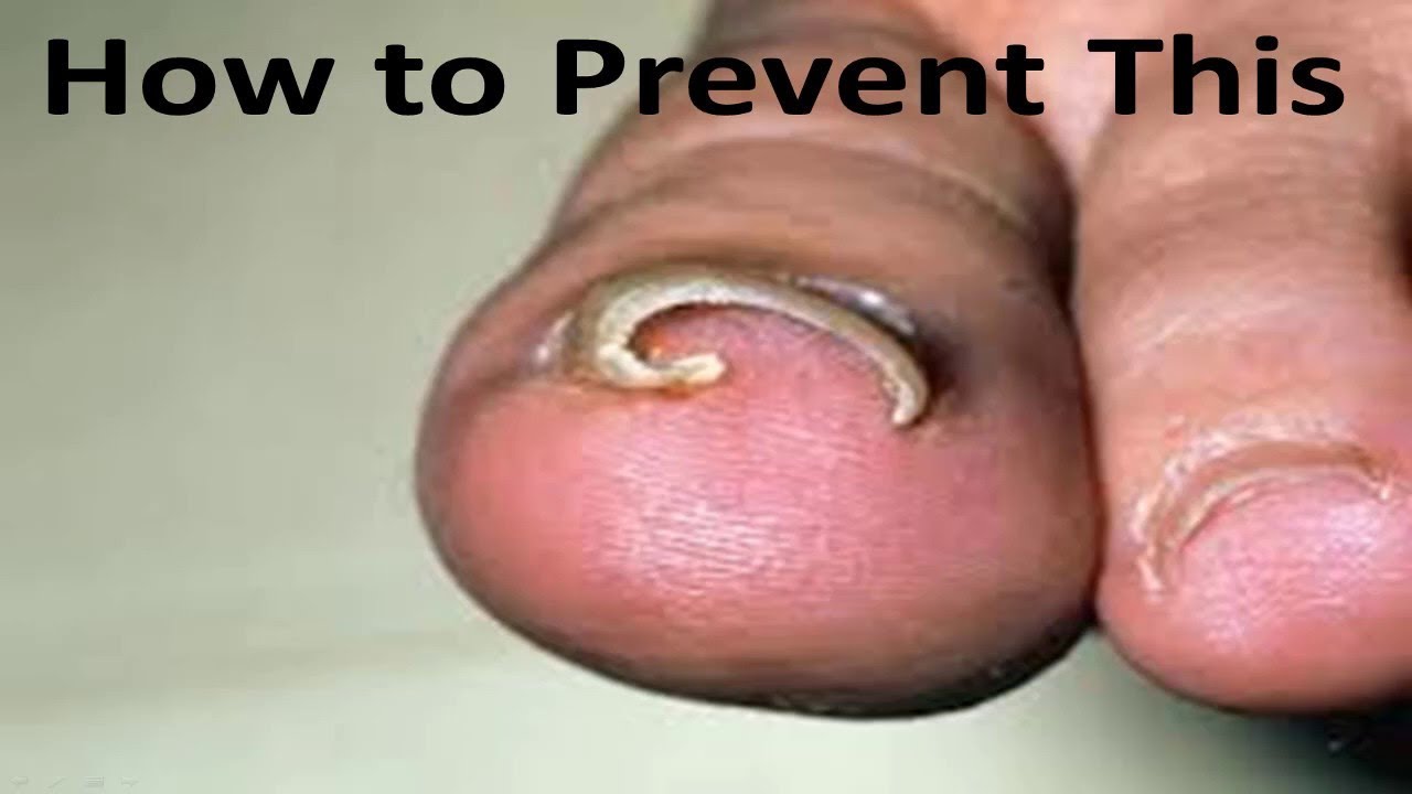Watch: Toenail Fungus Treatment in Howell, MI