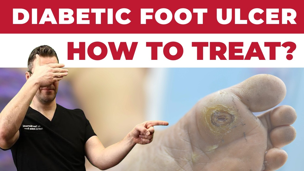 How to Treat a Diabetic Foot Ulcer [Early Signs, Causes & Treatment]