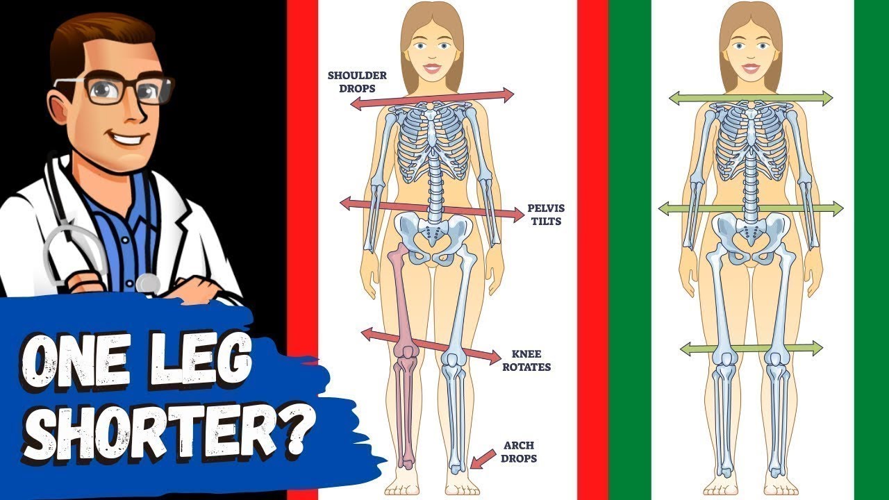 One Leg Longer than the Other Pain? [FIX Leg Length Discrepancy & LLD]