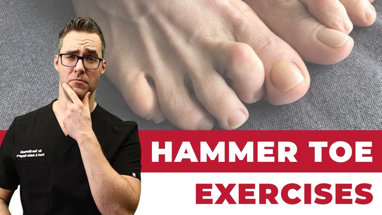 Hammer Toe Exercises, Stretches & Treatment [Claw Toes & Mallet Toes!]