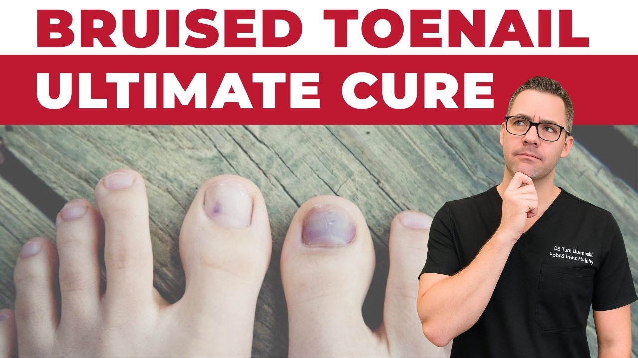 Black, Red or Bruised Toenail - *Ultimate Cure*