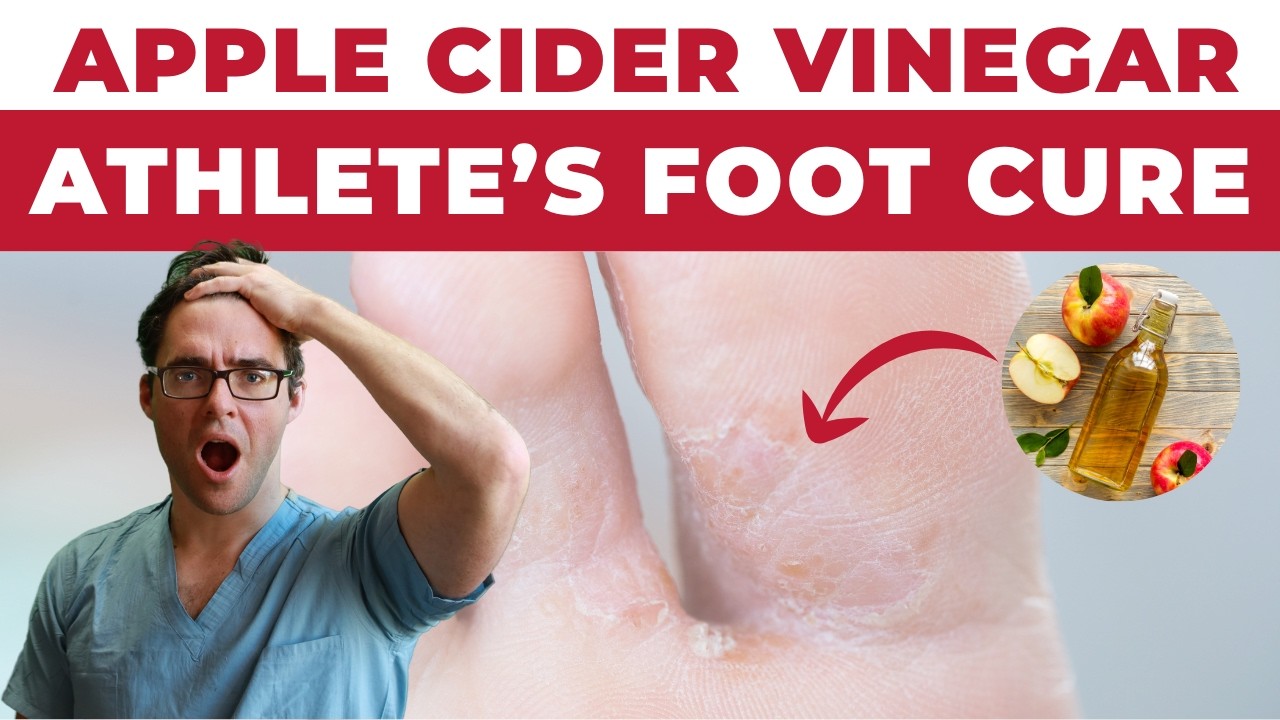 Athlete's Foot Fungus Cure [Apple Cider Vinegar Treatment!]
