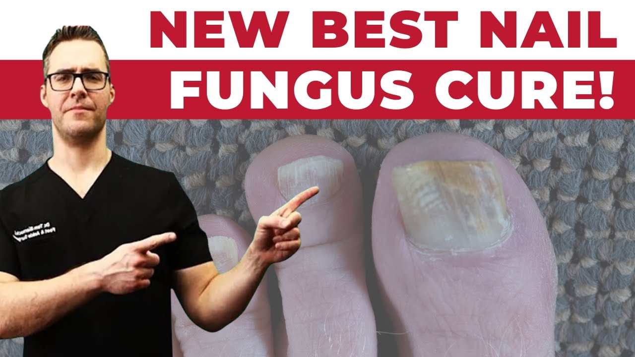 #1 NEW Best Toenail Fungus Treatments [Medications vs Creams vs Laser] | Dr. Tom Biernacki, DPM