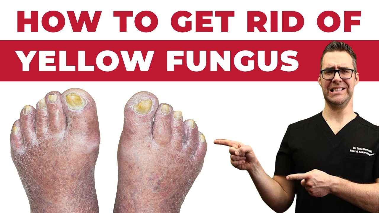 How to CURE Yellow Toenail Fungus & Toe Fungus [Remedies & Treatment]