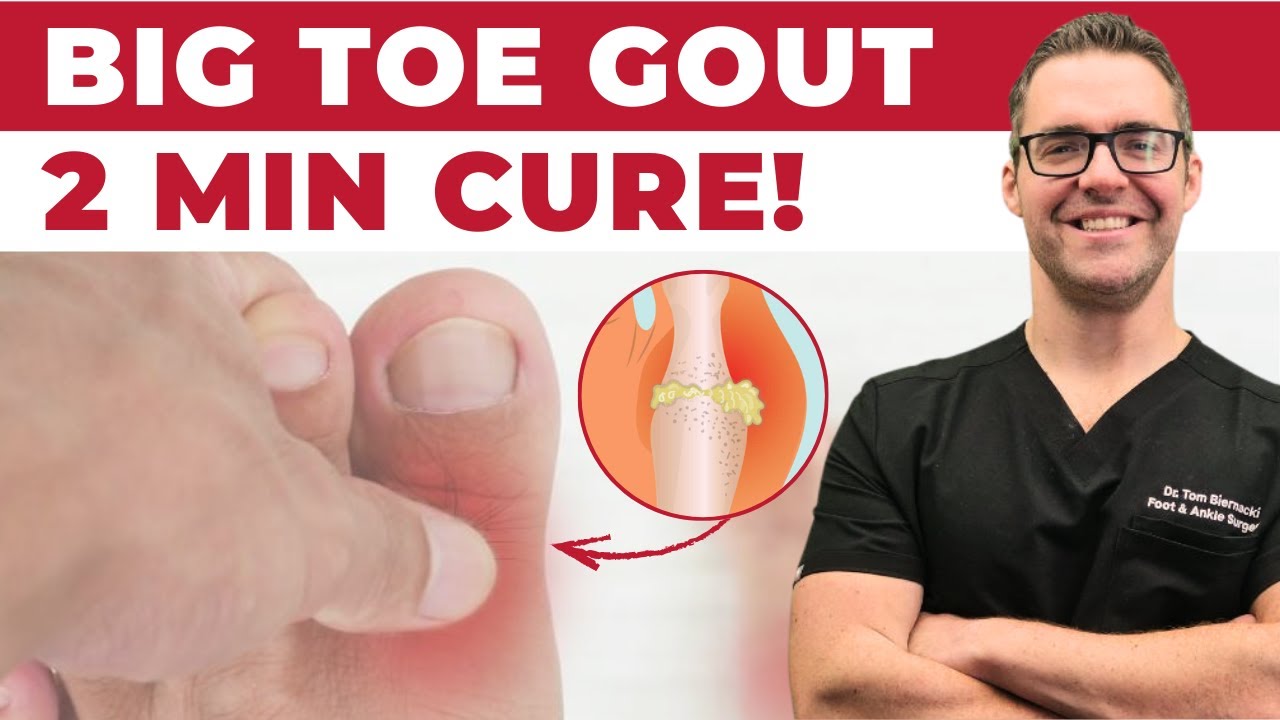 Gout Attack Treatment and Diet