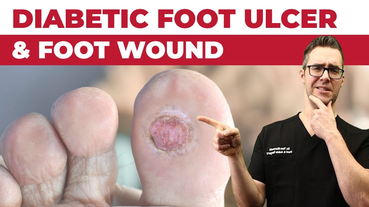 Diabetic Foot Ulcer & Foot Wound 101! [STOP Diabetic FOOT Infections]