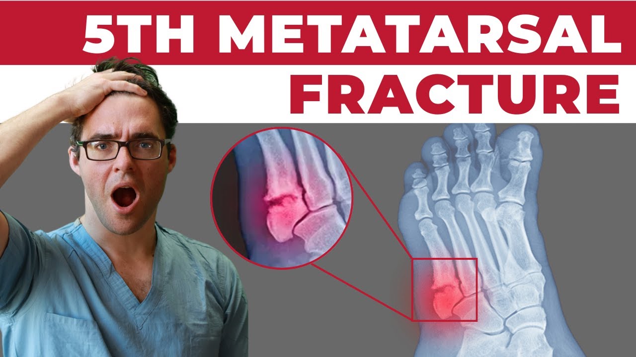 5th Metatarsal Jones Fracture [Recovery, Treatment & Surgery]